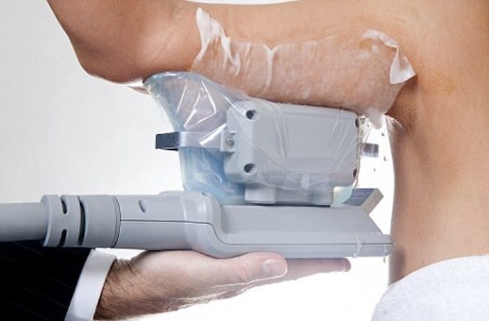 fat freezing arms Upper Edmonton