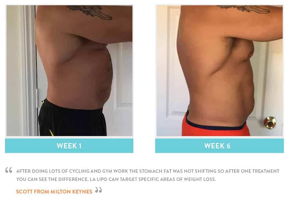 Before & After Stomach Fat Upper Edmonton
