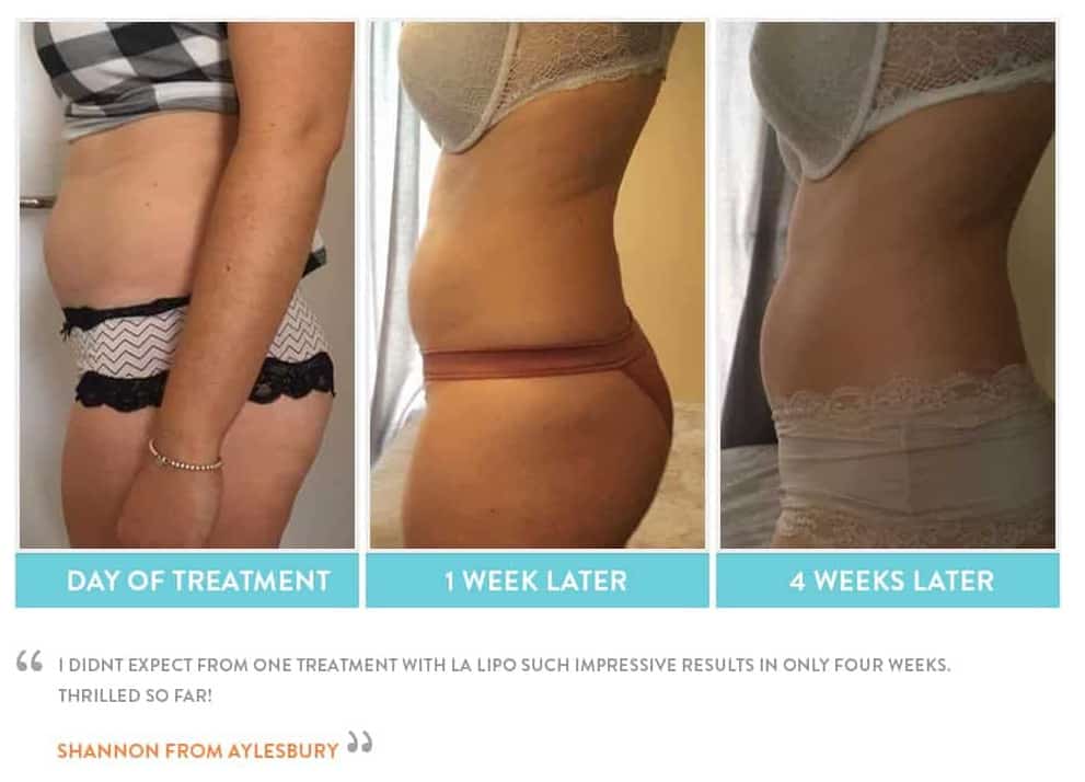 before, Cryolipolysis Upper Edmonton