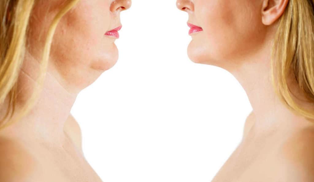 Double Chin treatment Upper Edmonton before and after results