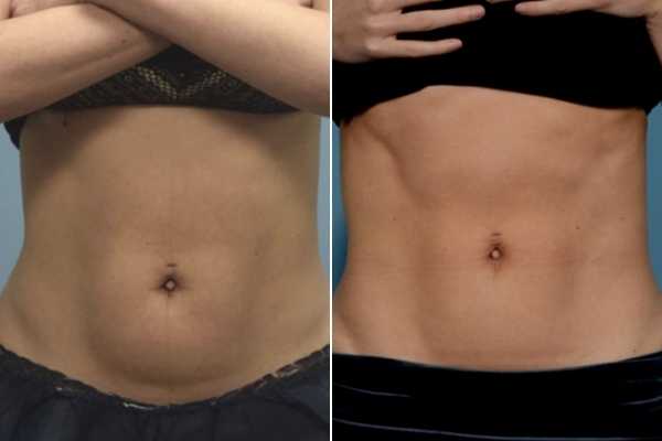 body sculpting FAQs Upper Edmonton