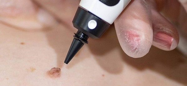 After Skin Tag Removal Upper Edmonton