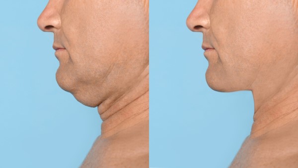 Which Non-Surgical Treatments Work Best for Jowls and Loose Skin Upper Edmonton?