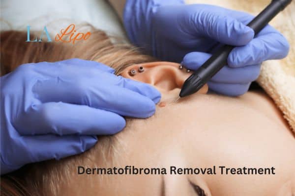 Dermatofibroma Removal Treatment Upper Edmonton