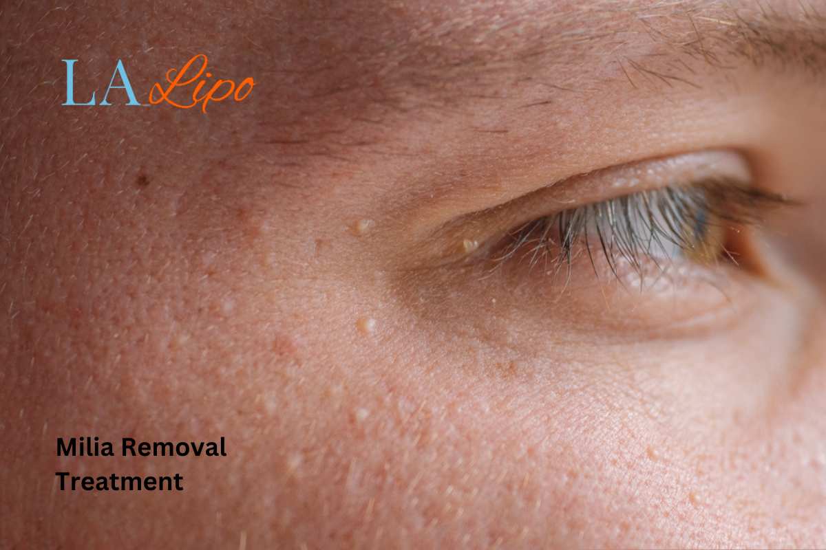 Cryopen Milia Removal: Is It the Easiest and Safest Option Upper Edmonton?