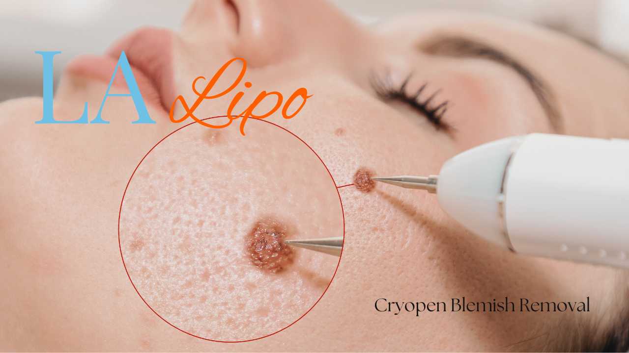 cryopen blemish removal Upper Edmonton Contact our team today!