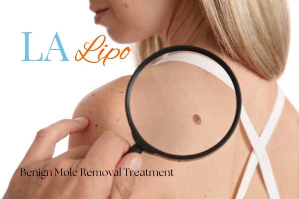 Woman having her inspection of blemish before mole removal Upper Edmonton
