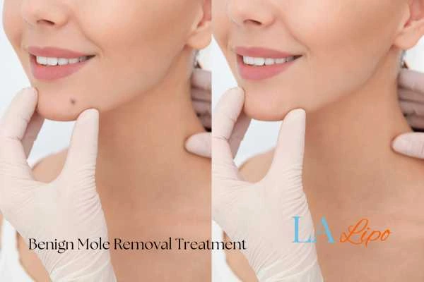 Before and after mole removal Upper Edmonton treatment