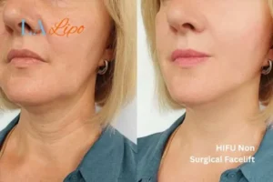 hi-fu for wrinkles Upper Edmonton before and after results