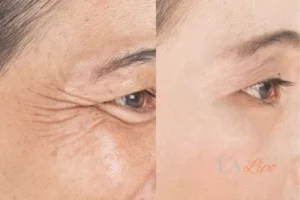 Before and after results of woman - HI-fu wrinkles reduction treatment Upper Edmonton