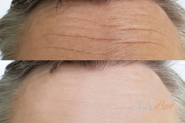 results of HIFU Upper Edmonton on mans forehead to help reduce lines and wrinkles