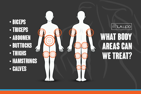 Graphic to show areas you can have LA-EMS Body Sculpting Upper Edmonton treatment.