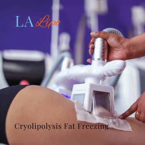 fat freezing - Cryolipolysis Upper Edmonton