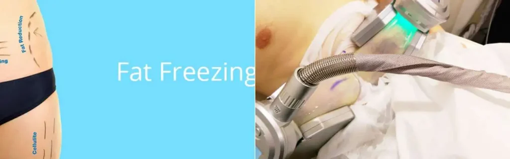 Fat freezing Upper Edmonton on multiple areas of the body