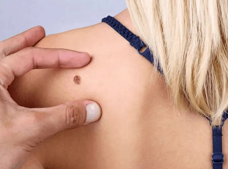 woman having mole removal Upper Edmonton consultation before treatment.