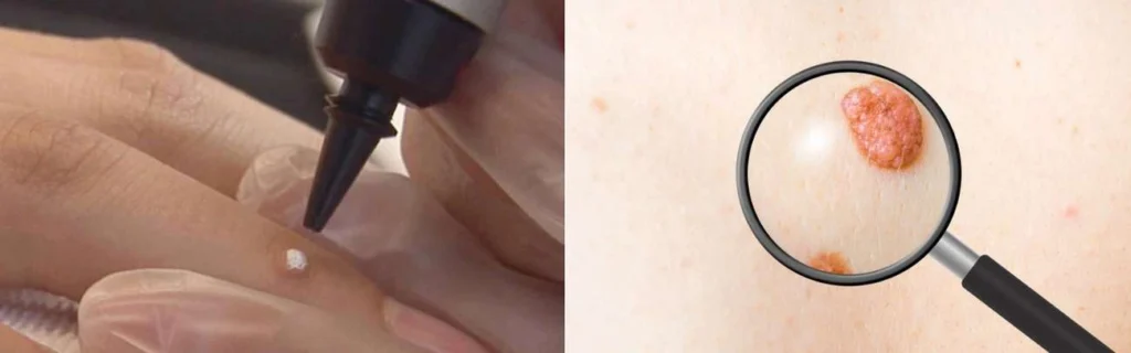 CryoPen practitioner Upper Edmonton assessing a benign mole before treatment