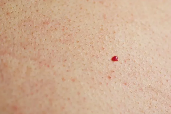 close up of a cherry angioma Upper Edmonton