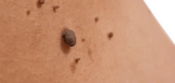 image of a skin tag Upper Edmonton
