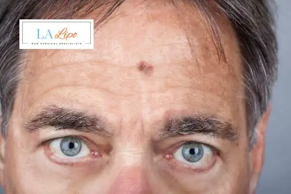Solar Lentigo Removal Upper Edmonton image of man with mark on his forehead
