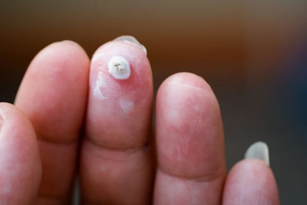 wart on person finger - cryotherapy to treat from LA LIPO Upper Edmonton