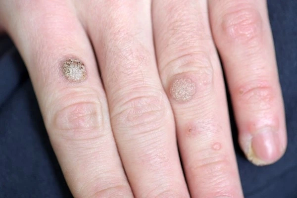 photo of warts on person hand - see wart removal Upper Edmonton from LA LIPO