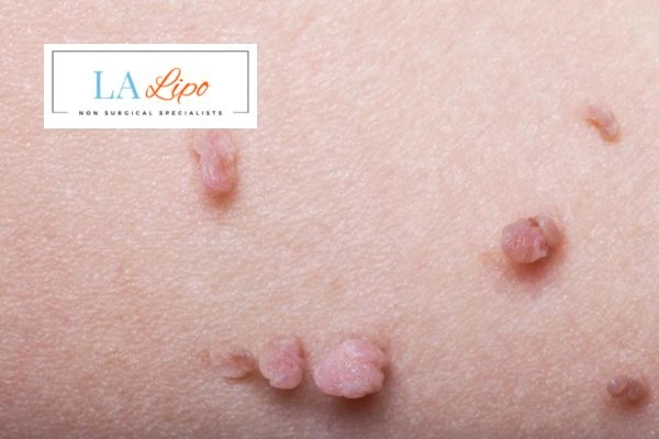 Does cryopen skin tag removal Upper Edmonton hurt? Find out now call our team today!