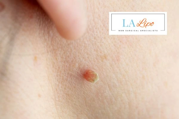 Book skin tag removal Upper Edmonton today speak to our team now!