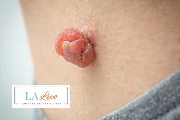 Interested in skin tag removal Upper Edmonton? Concerned about the pain? Find out more today!