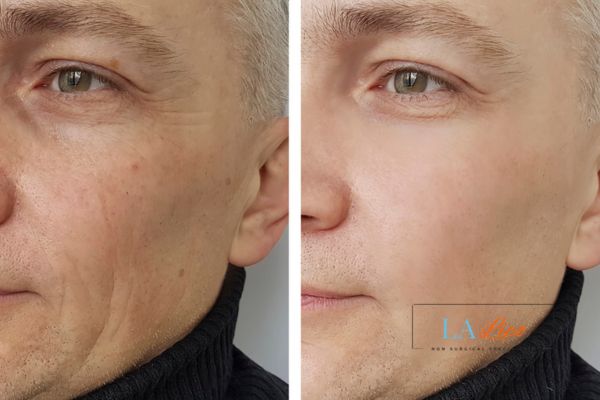 See the amazing results of Morpheus8 Treatment Upper Edmonton!