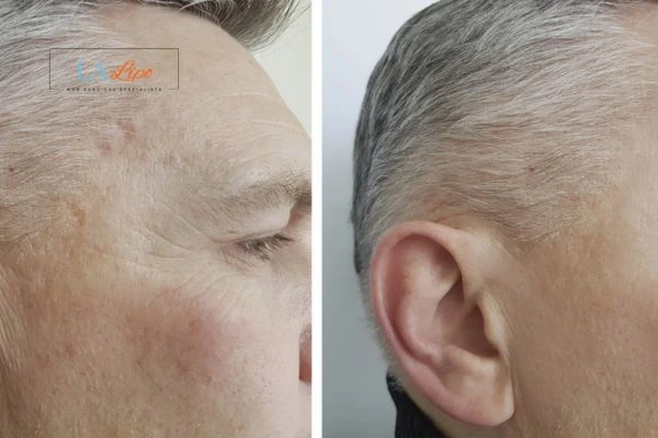 Mens Before & After Morpheus 8 Results Upper Edmonton