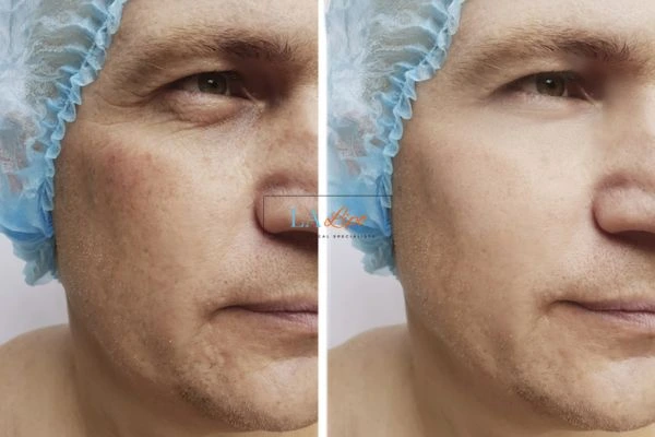 Before and after Morpheus 8 Results Upper Edmonton