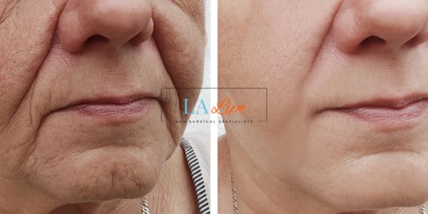 Older lady deeper wrinkle reduction - LA LIPO Morpheus 8 Results Upper Edmonton