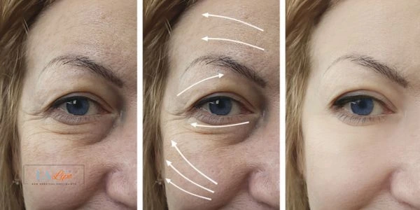 Amazing eye lift Morpheus 8 results Upper Edmonton