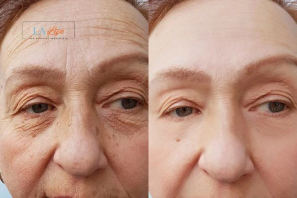 The powerful benefits of Morpheus8 Treatment Upper Edmonton - Call Our team today!