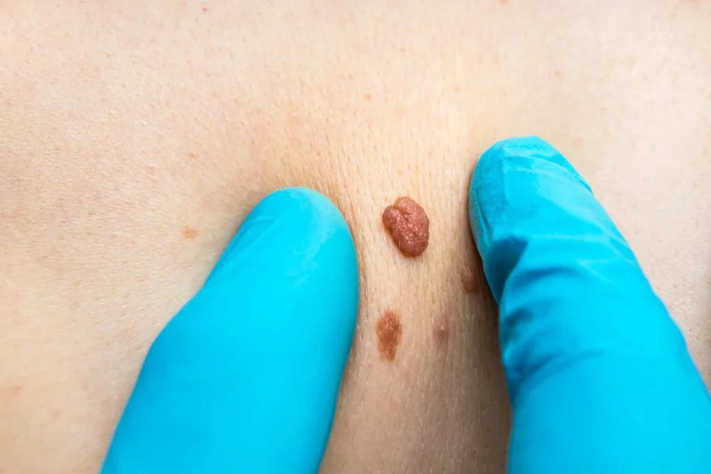 LA LIPO Cryopen Lesion Removal Prices Upper Edmonton