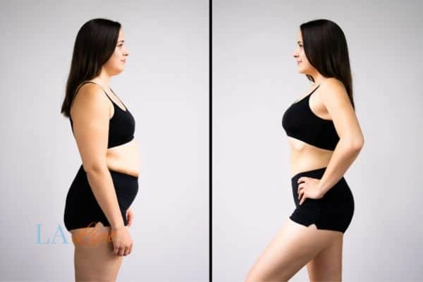 Picture of womans before and after using LA-EMS body sculpting to improve her core strength Upper Edmonton
