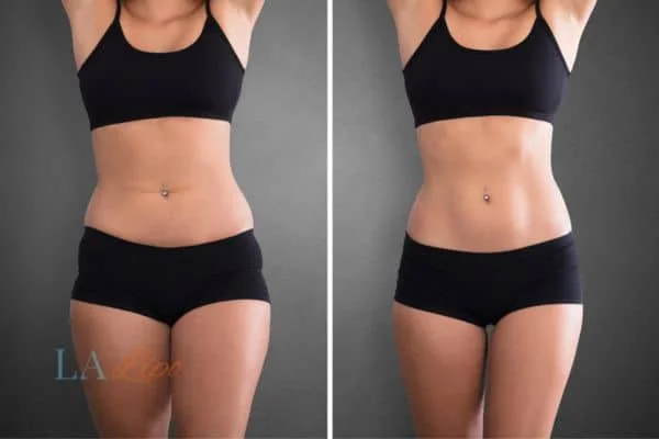before and after results of non-surgical treatment to help a woman's body image and mental health Upper Edmonton
