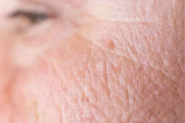 close up picture of a woman's face showing an age spot Upper Edmonton