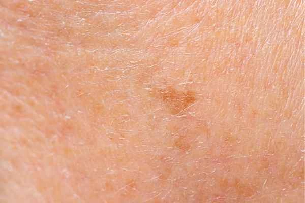 close up picture of age spots Upper Edmonton