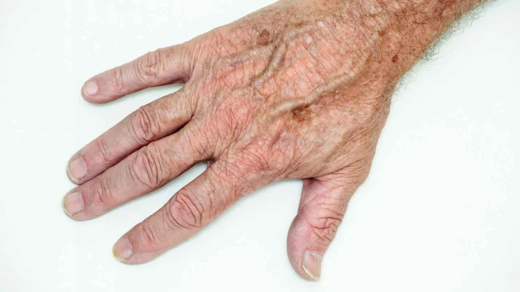 Male hand showing age spot Upper Edmonton