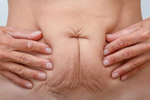Image of a woman's stomach with loose skin - example of skin tightening Upper Edmonton options