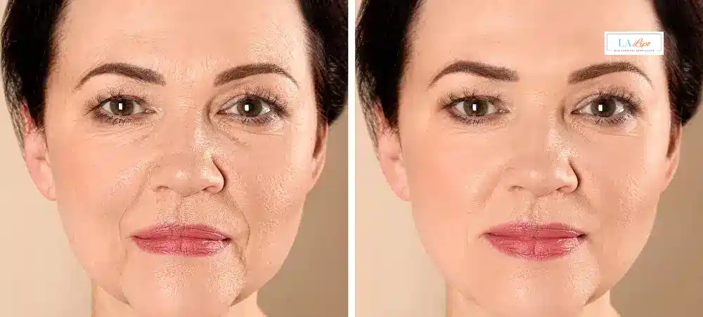 How Long Does It Take to See Results and How Long Do They Last Upper Edmonton?