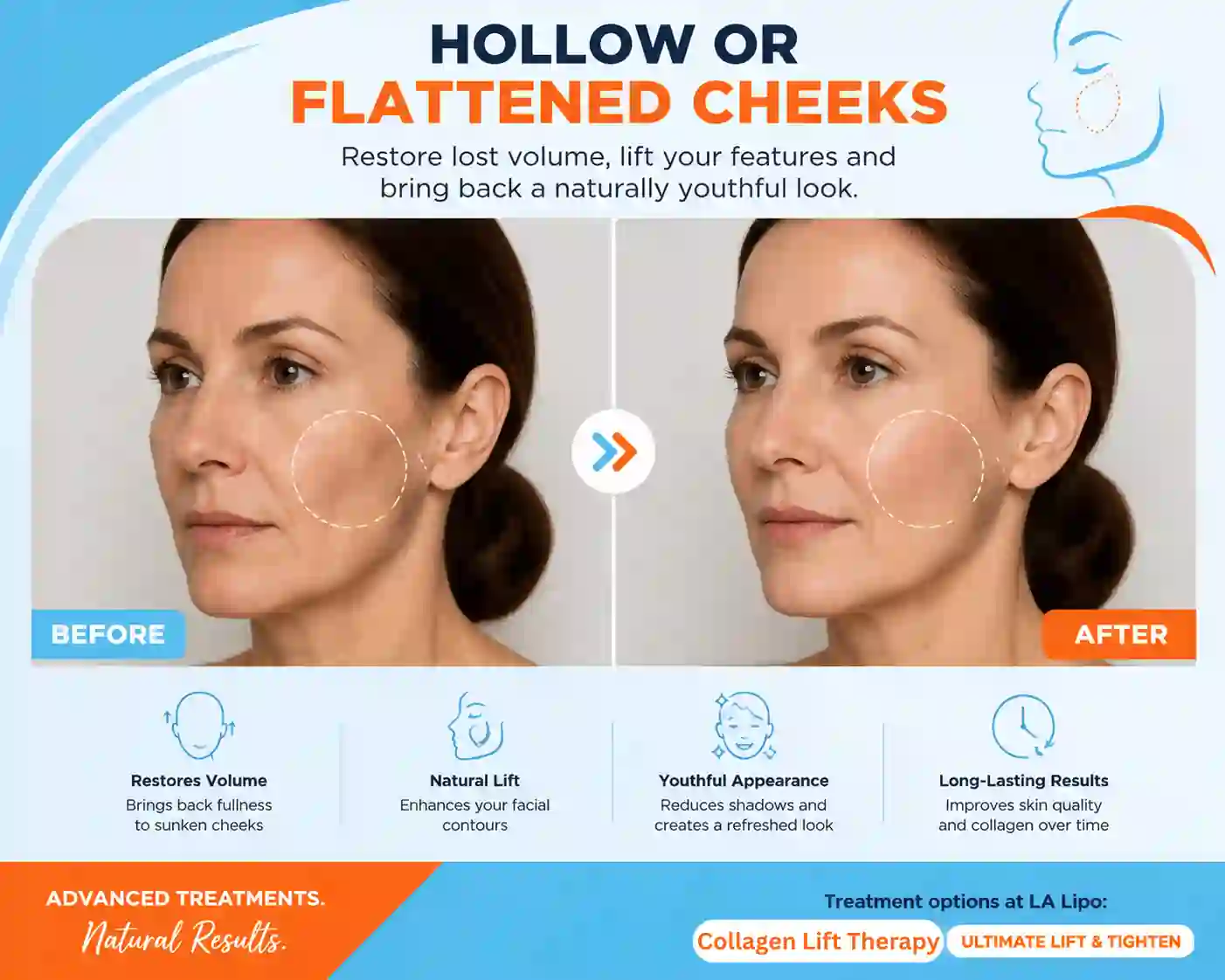 Sign #4: Hollow or Flattened Cheeks Upper Edmonton